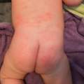 Ausschlag?Flecken? bei meinem Baby