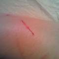 Blutvergiftung oder Grippe?