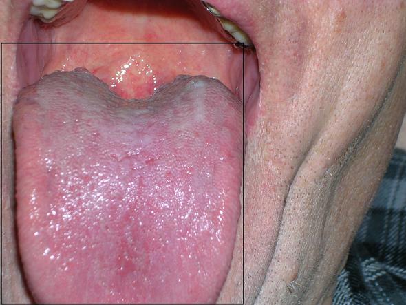 candida darm behandlung