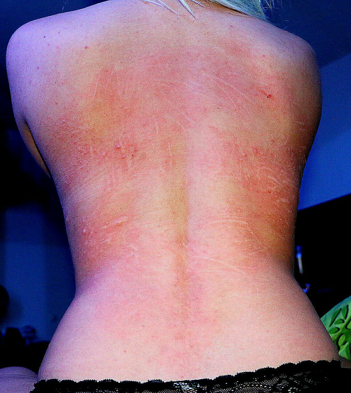 Juckende Stelle Am Rücken