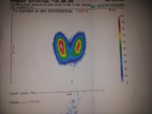 45+ Szintigraphie schilddruese bilder erklaeren , Schilddrüsenuntersuchung.... (Schilddrüsenhormone, Schilddrüse)