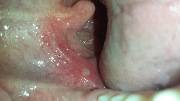 Ist das eine Aphte? (Hals, Eiter, Angina) Ist das eine Aphte? (Hals, Eiter, Angina)