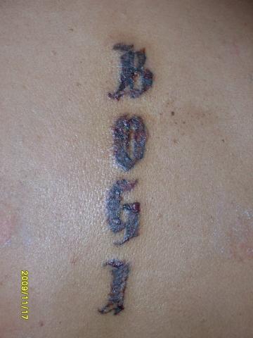 Tattoo 5 Tage nach 1. Behandlung - (Haut, Dermatologie, hautarzt)