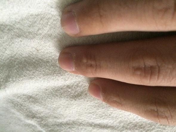 - (Schmerzen, Finger, Wunde)