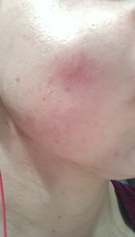 Ist der Pickel bzw. die Beule an der Wange normal? (Schmerzen) pickel in der wange innen