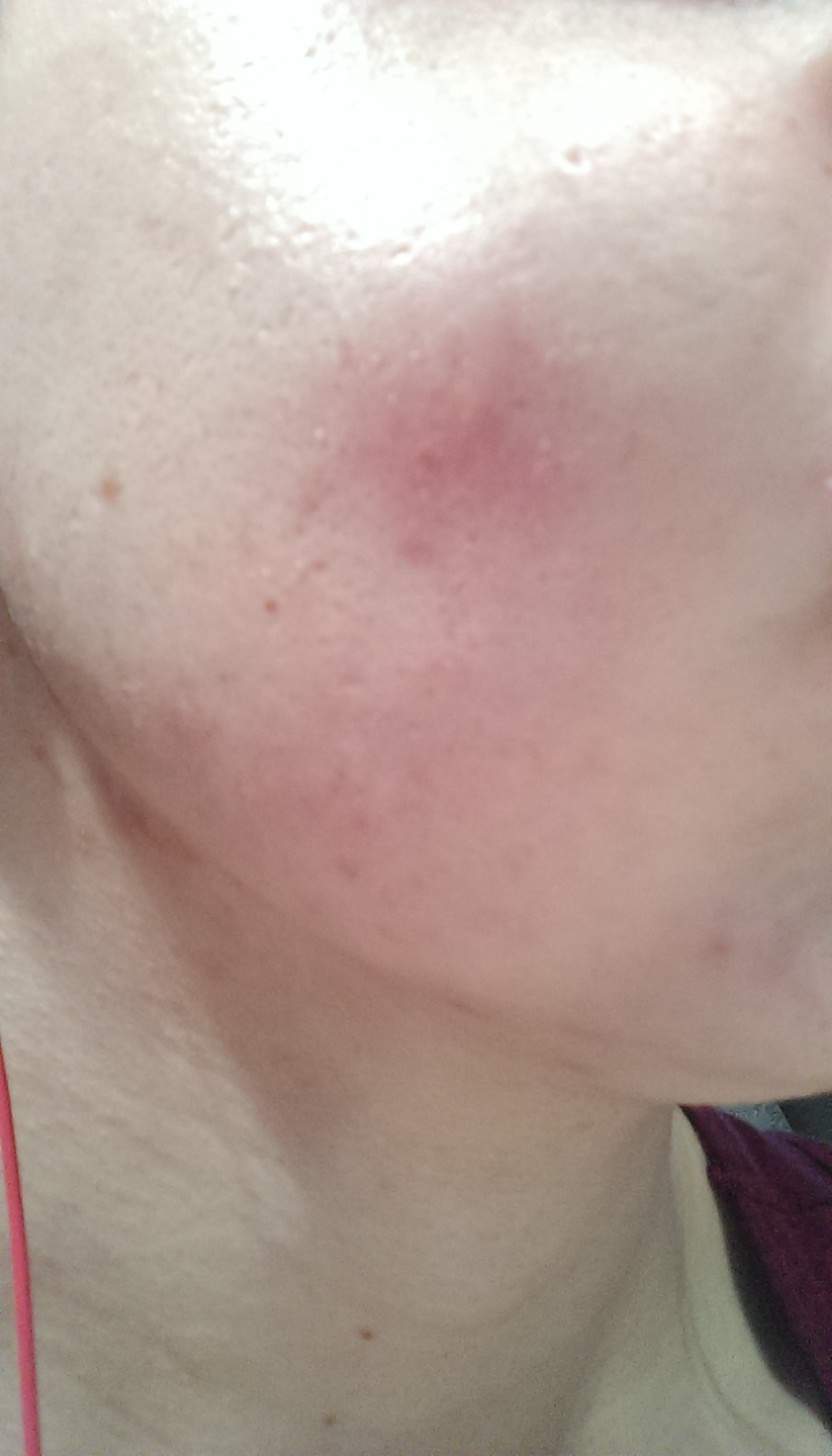 Ist der Pickel bzw. die Beule an der Wange normal? (Schmerzen)