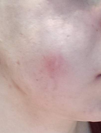 Ist der Pickel bzw. die Beule an der Wange normal? (Schmerzen)