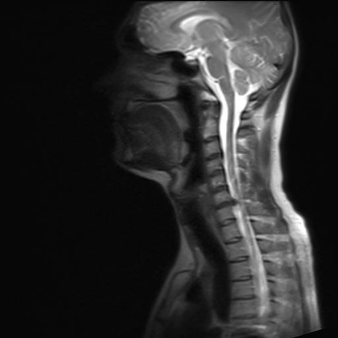 MRT Bild vom Nacken diagnostizieren: ist der Wirbel zu tief drin