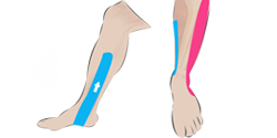 Ich würde es ungefähr so machen. Einen rechts und einen links vom Knochen. - (Physiotherapie, Kinesiotape, Shinsplints)