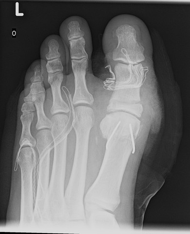 - (OP, Hallux rigidus, Großzehenarthrose)