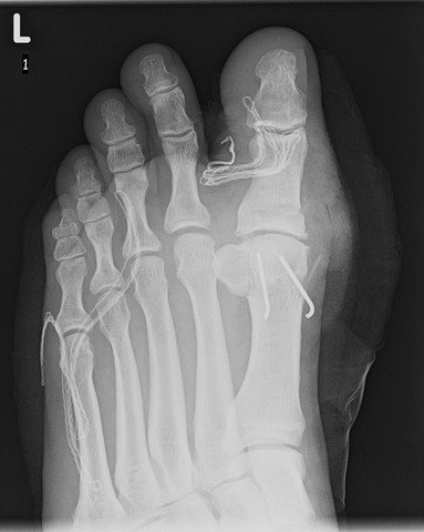 - (OP, Hallux rigidus, Großzehenarthrose)