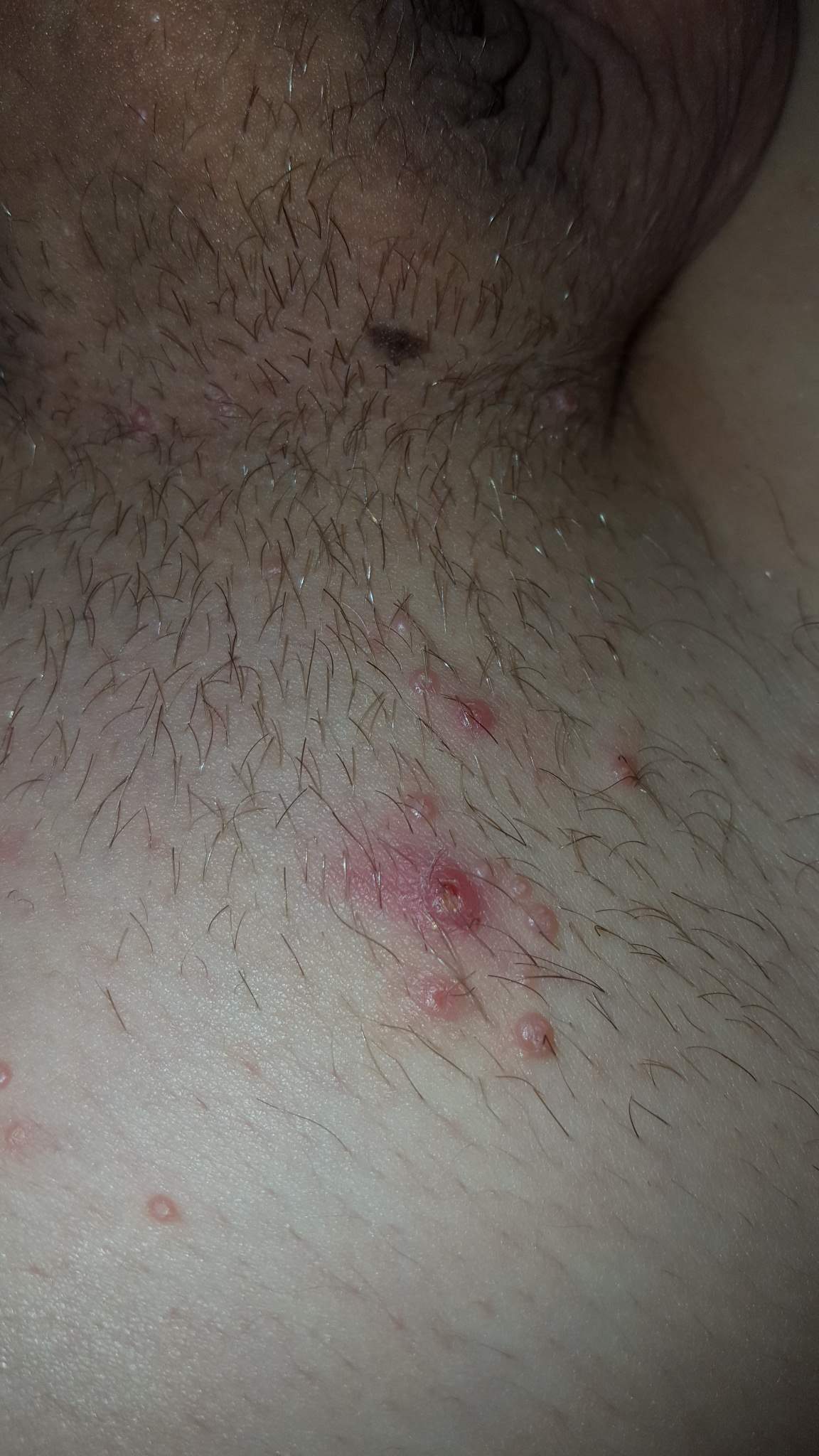 Sind das nur Pickel oder Warzen? (Geschlechtskrankheit, Rasieren) Sind das nur Pickel oder Warzen? (Geschlechtskrankheit, Rasieren)