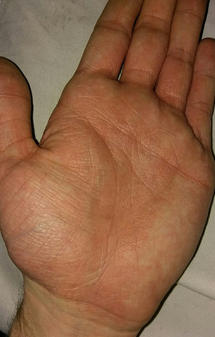 Ausschlag Fuss Sohle Handflache Und Kribbeln Haut Gesundheit Fusse Ausschlag Fuss Sohle Handflache Und Kribbeln Haut Gesundheit Fusse