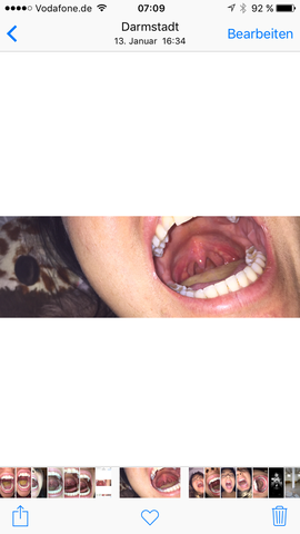 Halbes Jahr Nach Mandeln Op Coblation Immer Noch Probleme Schmerzen Operation Halbes Jahr Nach Mandeln Op Coblation Immer Noch Probleme Schmerzen Operation