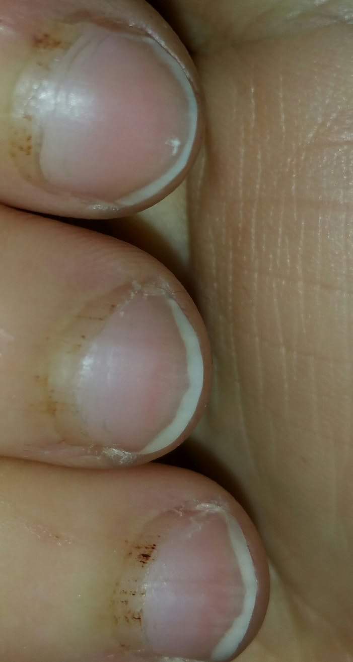 Was kann das an der Nagelhaut sein? (Dermatologie, Fingernägel)