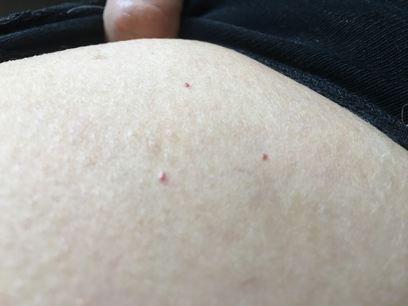 Kleine Rote Punkte Auf Der Haut Harmlos Kleine Rote Punkte Auf Der Haut Harmlos