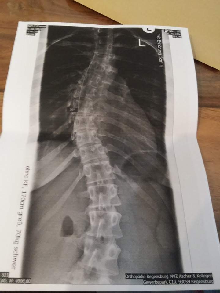 Wie hoch ist der Grad meiner Skoliose? (Röntgen)