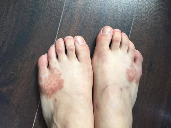 aktuelles Bild der Flecken - (Dermatologie, Flecken am Fuß )