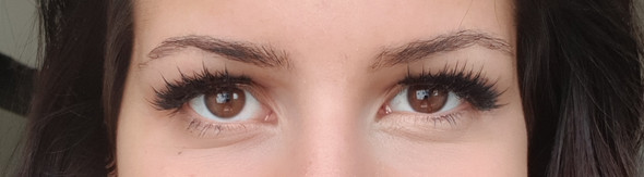 - (Augen, Gerstenkorn)
