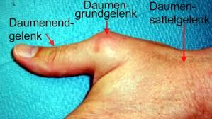- (Schmerzen, Daumen, sehnenscheidenentzündung)