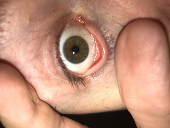 Das Auge - (Augen, Bindehautentzündung, gelblich)