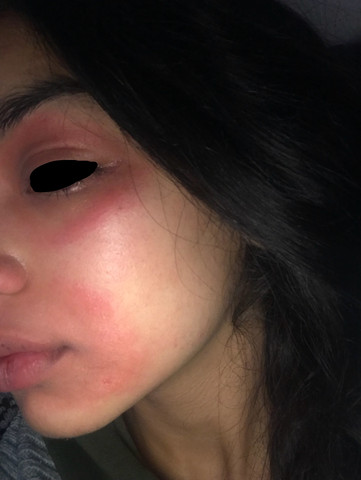 - (Haut, Allergie, Ausschlag)