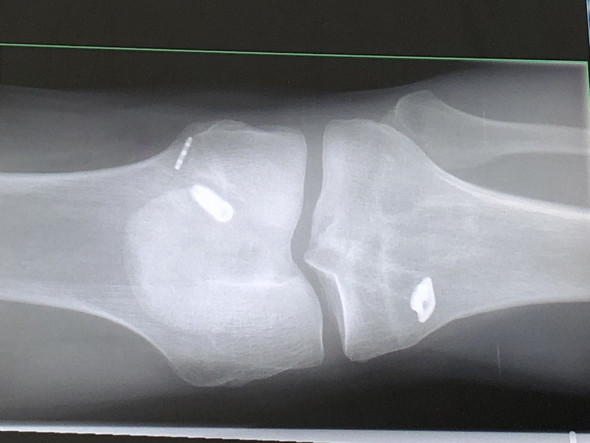 Ruckstande Nahtmaterial Schrauben Nach Kreuzband Op Operation Orthopadie Knoten Ruckstande Nahtmaterial Schrauben Nach Kreuzband Op Operation Orthopadie Knoten