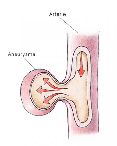 Bilduntertitel eingeben... - (Aneurysma)