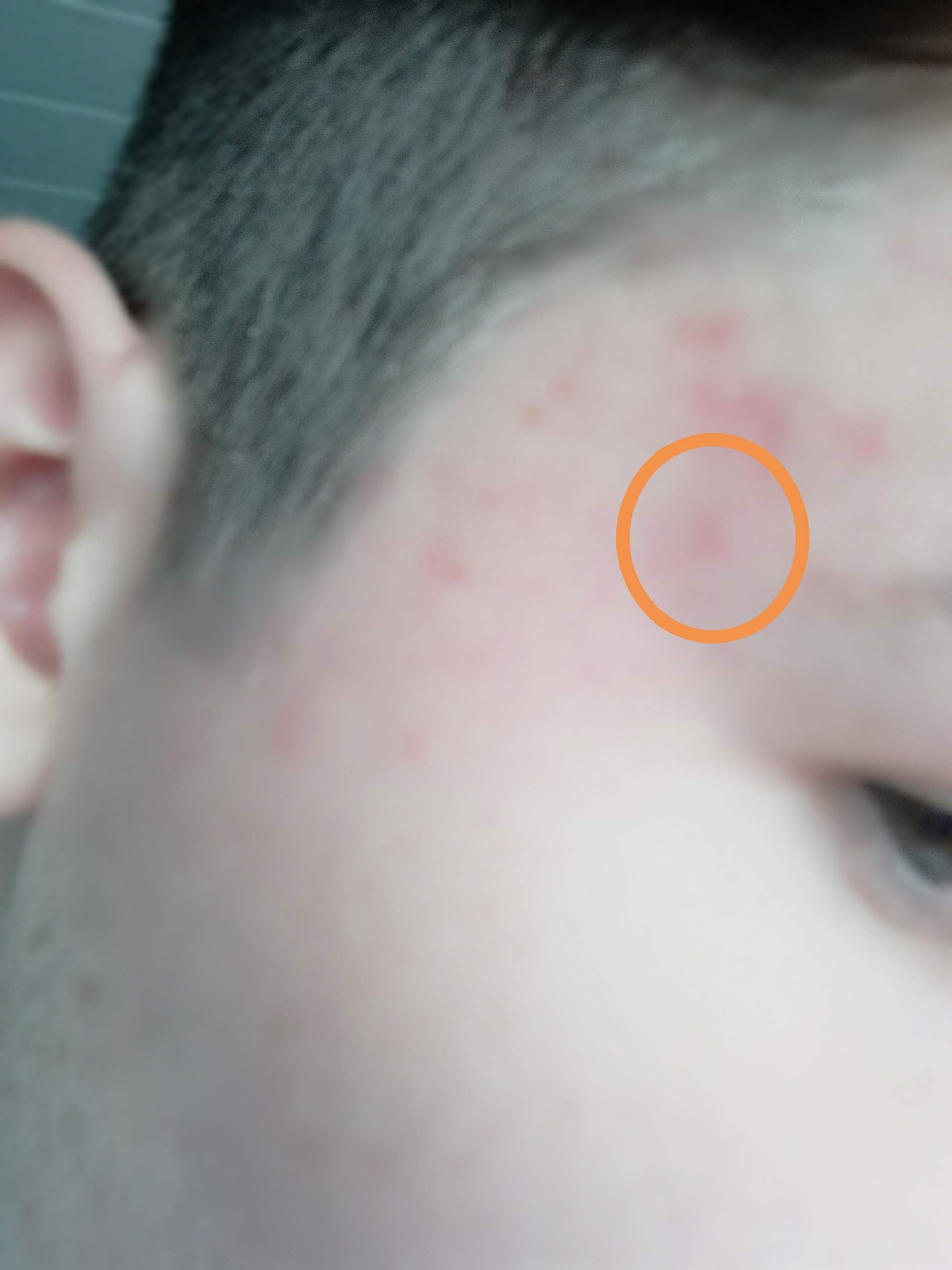 Pickel am Kopf = Blutvergiftung? (Angst, Urlaub) pickel mit blut gefüllt im gesicht