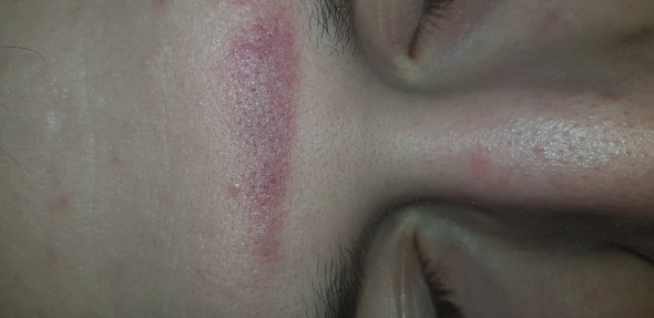 - (Haut, Gesicht)