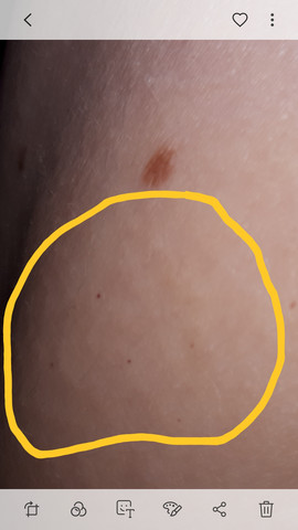 - (Haut, Leukämie)
