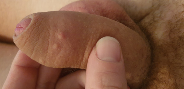 - (Haut, Gesundheit, Penis)