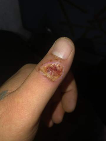 - (Hand, Verbrennungsgrad)