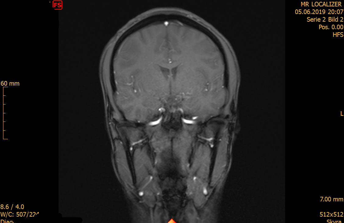 Schädel MRT Localizer Was sind das für weiße Stellen?