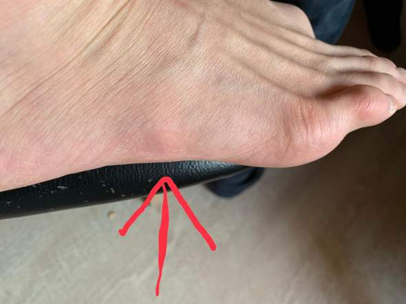 Plotzlicher Schmerz Und Schwellung An Der Aussenseite Vom Fuss Plotzlicher Schmerz Und Schwellung An Der Aussenseite Vom Fuss