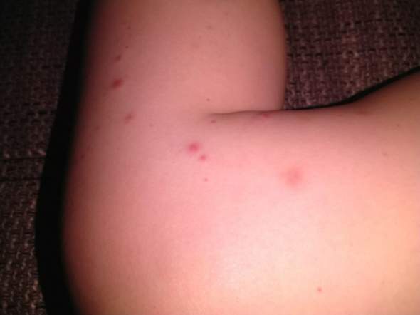 Ausschlag Bei Kind 7 Nur An Den Beinen Und Sonst Keine Symptome Was Ist Das Kinder Ausschlag Bei Kind 7 Nur An Den Beinen Und Sonst Keine Symptome Was Ist Das Kinder