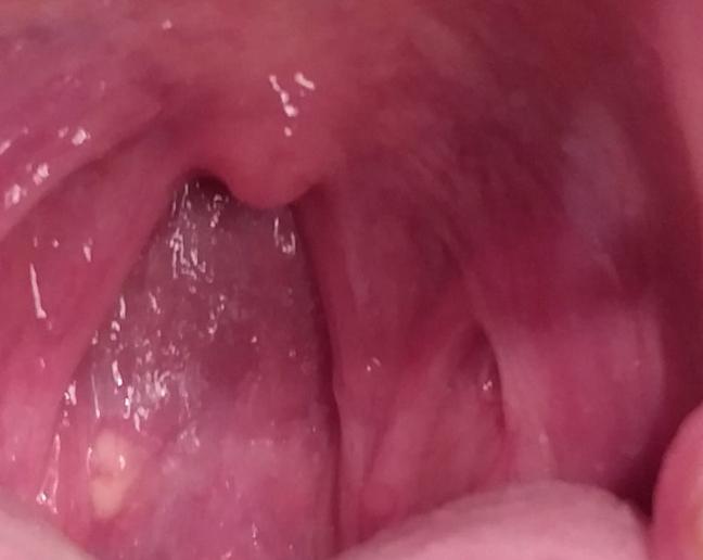 Was ist das für ein eitriger Knoten im Rachenraum? (Rachen)
