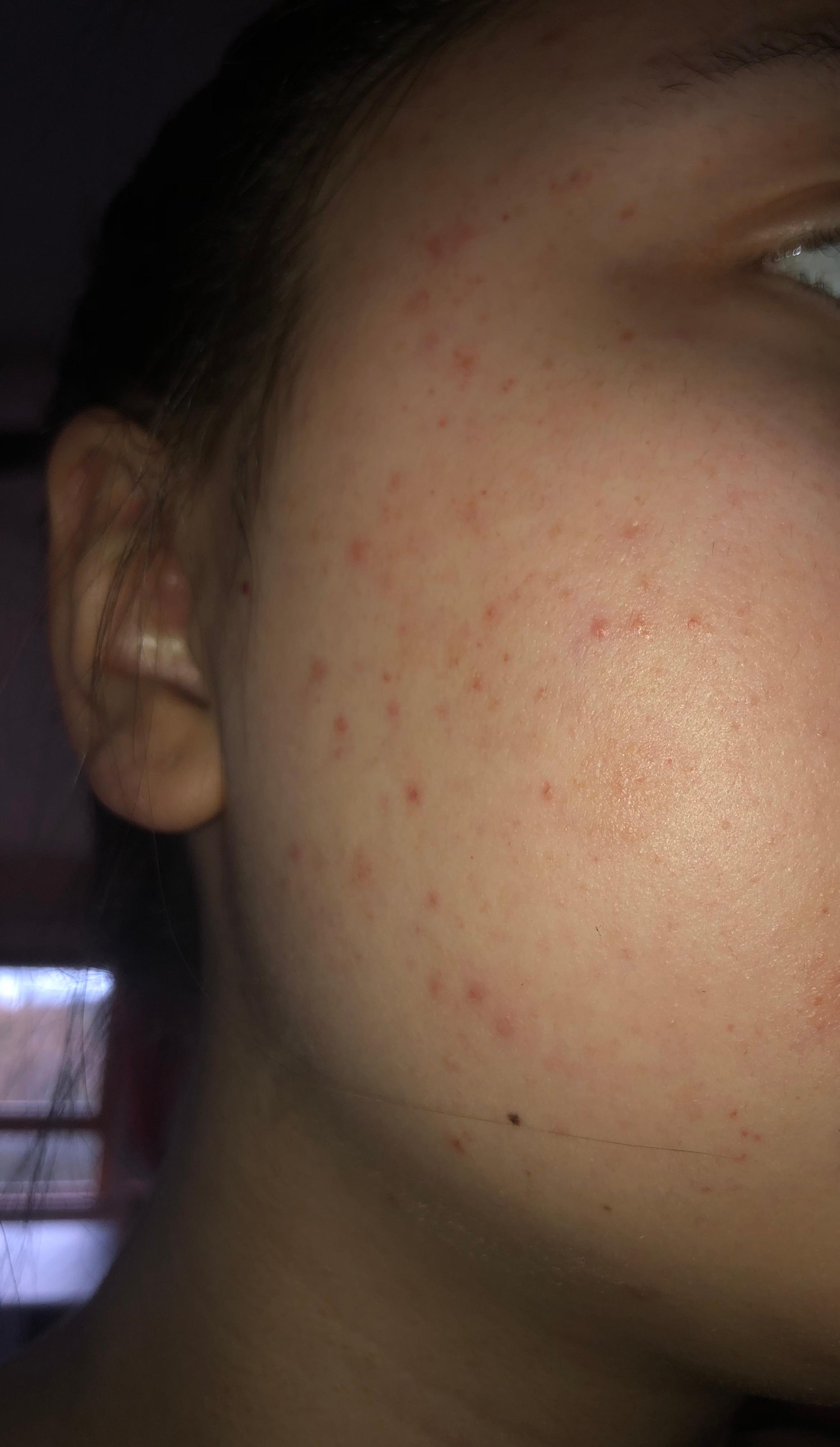 Rote Pickelchen im Gesicht? (Haut, Pickel, Ausschlag) pickel mit blut gefüllt im gesicht