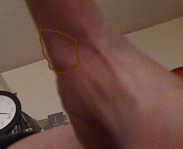 aufnahme 2 - (Hand, Knoten, Daumengelenk)