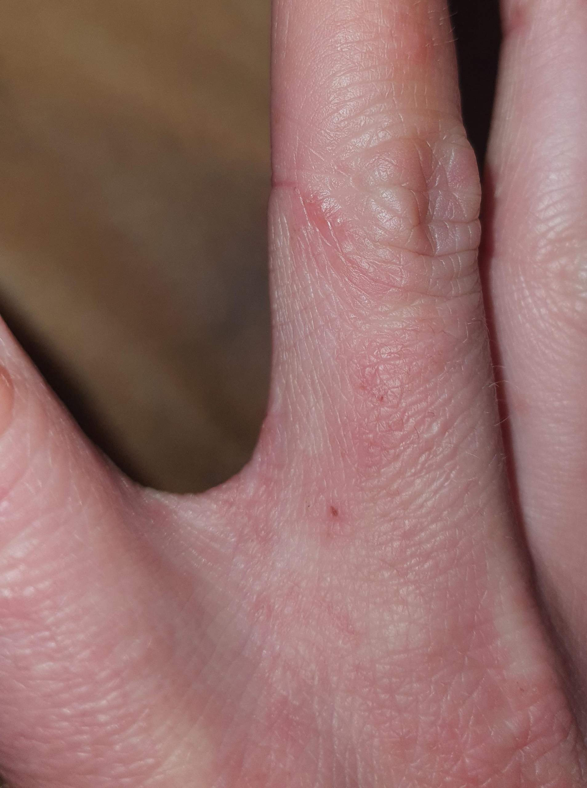 ist das Ekzem oder krätze? (Juckreiz)