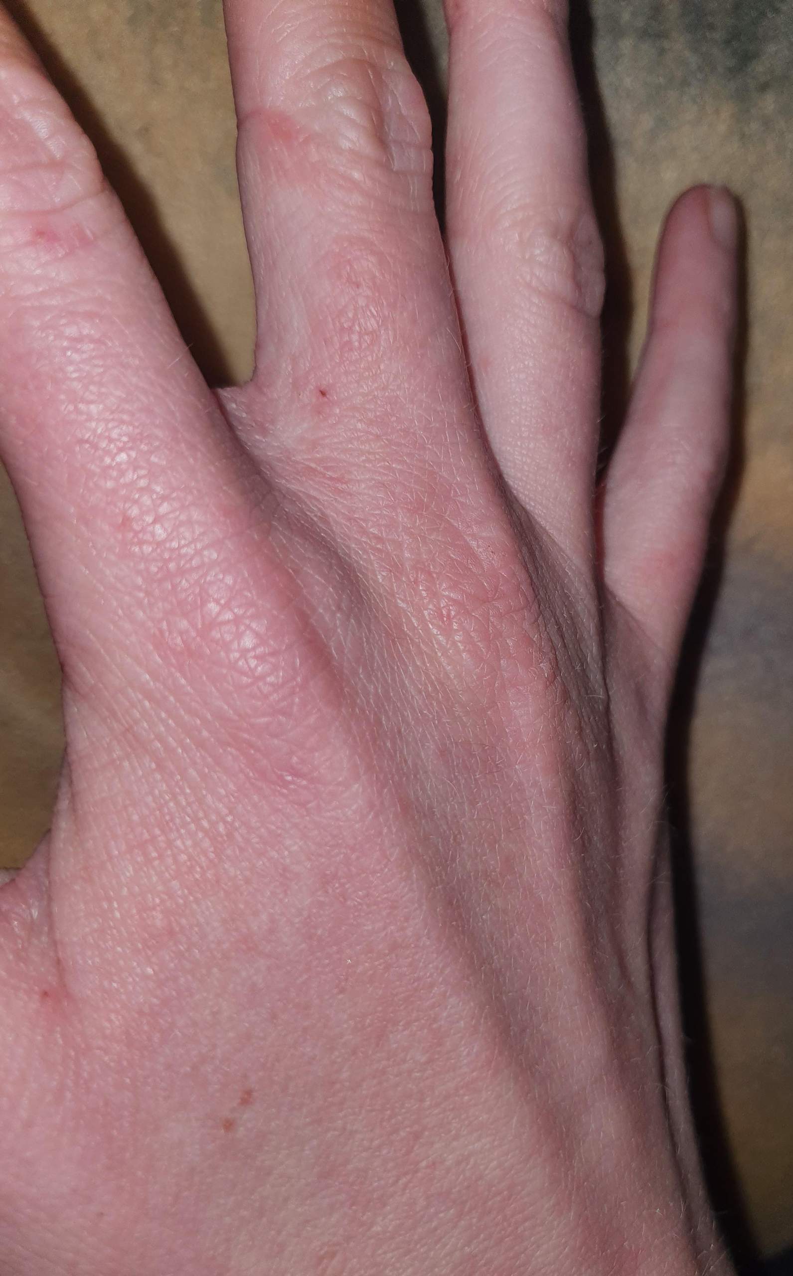 ist das Ekzem oder krätze? (Juckreiz)