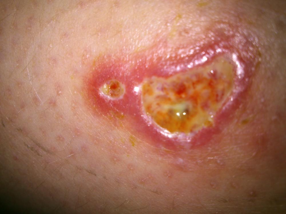 Die äusserliche Hämorrhoide wie sieht aus und als, zu behandeln