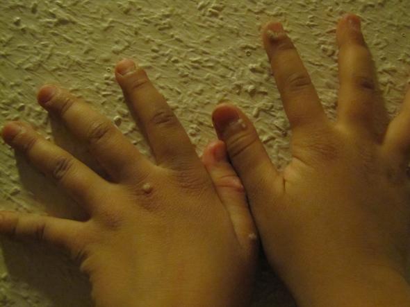 Die Poliklinik gribok der Nägel auf den Beinen