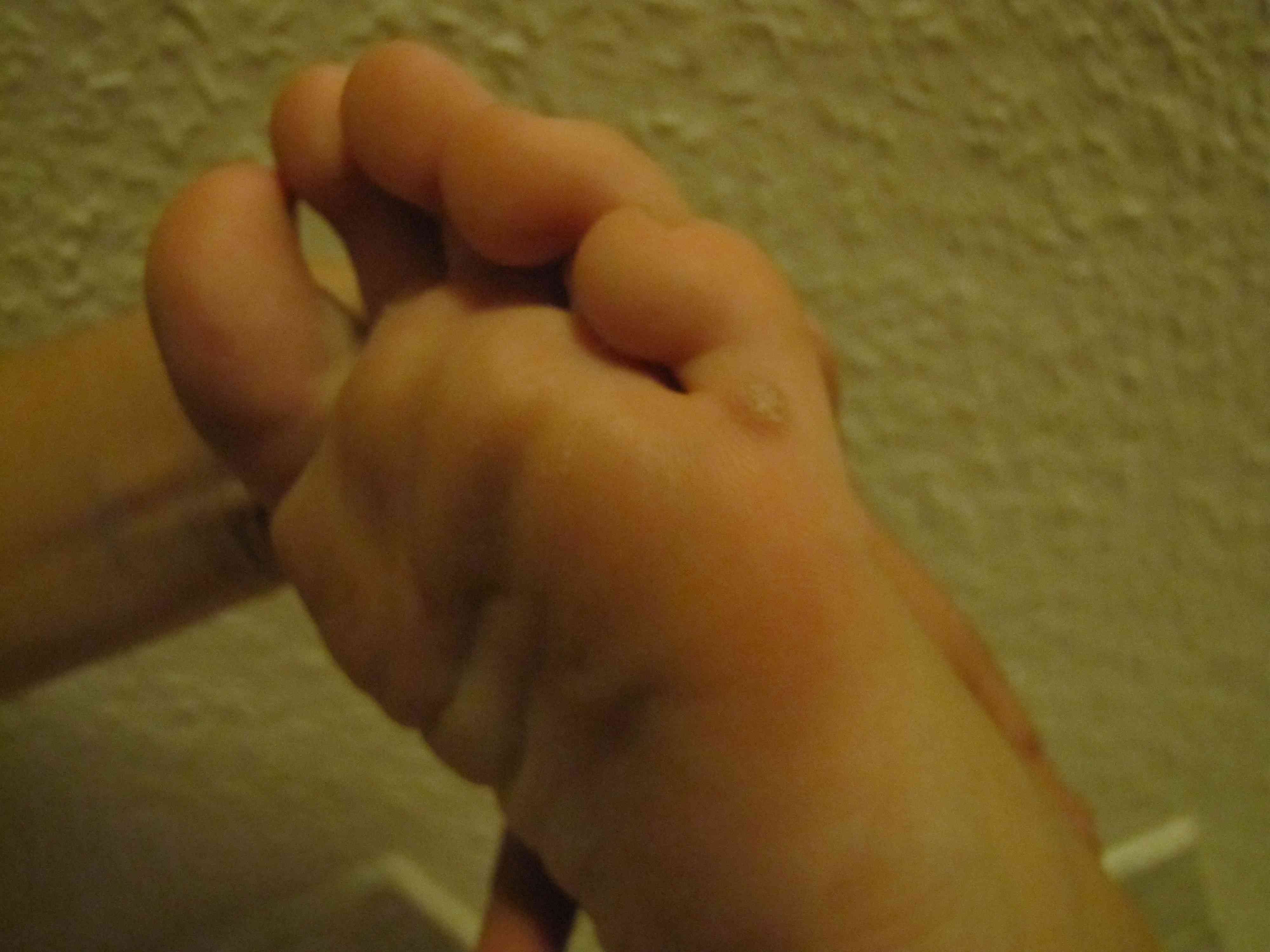 Wie Sie gribok auf dem Glied zu behandeln