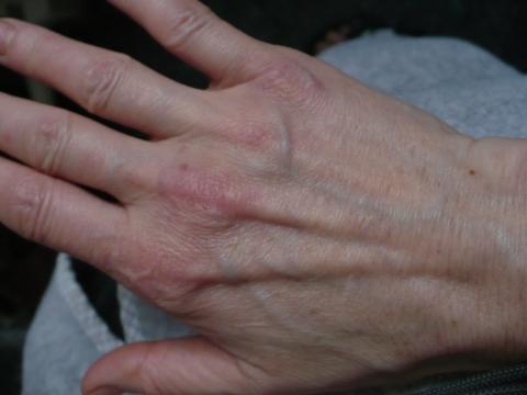 Als gribok der Schleimhäute zu behandeln