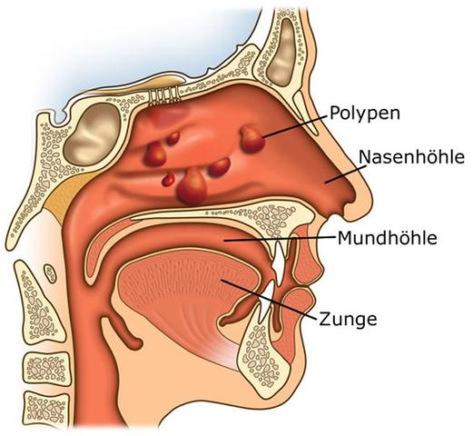 Kaum Luft Durch Nase Cortison Atmen Nasenspray Kaum Luft Durch Nase Cortison Atmen Nasenspray