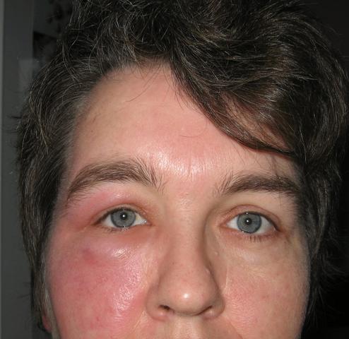 Gesichtsrose (Erysipel) seit letztes Jahr November (Haut, Au Die Lymphknoten am Hals sind auch angeschwollen und hier .ebenso als Beulen...