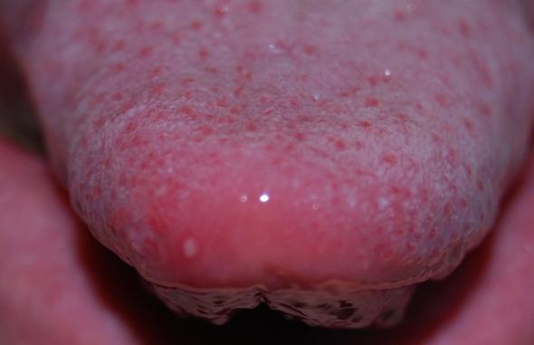 Blaschen Auf Der Zunge Wunde Blaschen Auf Der Zunge Wunde