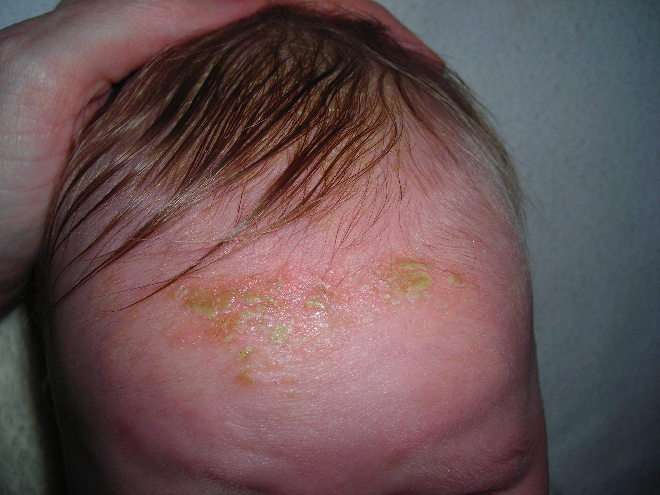 Babyakne oder Neurodermitis? (Juckreiz, Baby, Akne)