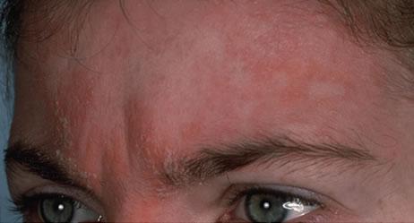 Neurodermitis  - (Hautprobleme, Kopfhaut, Neurodermitis)